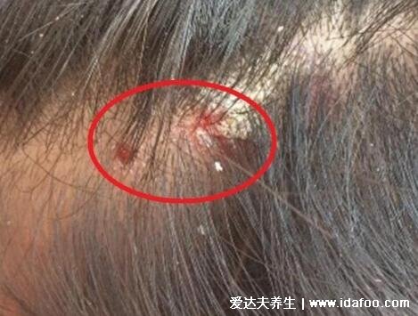 初期脂溢性皮炎图片和症状，头皮上有大块头皮屑还有结痂
