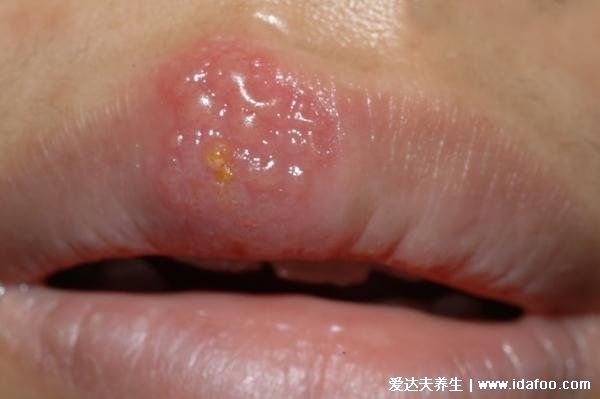 嘴上疱疹和上火水泡的区别图，口唇疱疹成簇聚集会痒和灼热