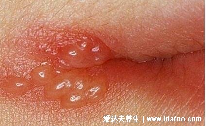 嘴上疱疹和上火水泡的区别图，口唇疱疹成簇聚集会痒和灼热