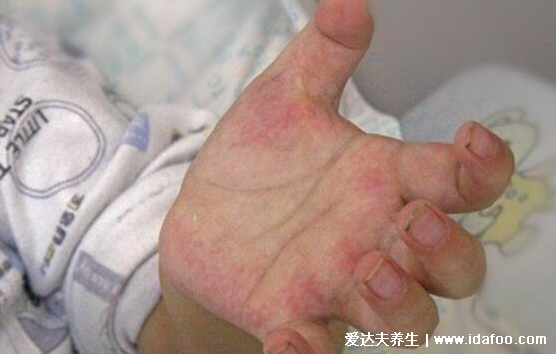 白血病初期针孔小红点图片，大片紫红色瘀斑不高出皮肤不褪色