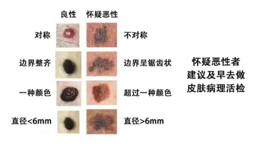 黑色素瘤早期症状图片，看颜色/大小/形状（锯齿状直径大5毫米） 