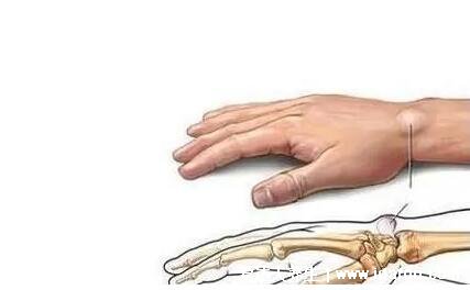 手腕腱鞘囊肿图片，生长缓慢可出现酸胀感(直径一般不超2cm)