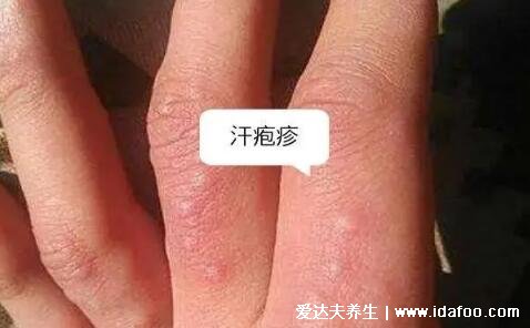汗疱疹图片初期症状图片，有水疱干后脱皮有瘙痒灼烧感