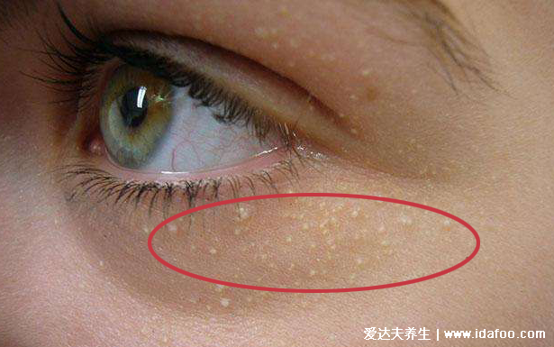 眼睑脖子和腋下长的小肉粒是什么，到底是不是感染HPV病毒