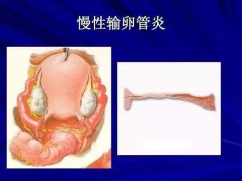 慢性输卵管卵巢炎的注意事项有哪些