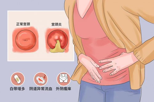 女性出现哪些异常情况时是急性宫颈炎的表现