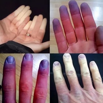 手指上有这4个症状可能是疾病找上门了