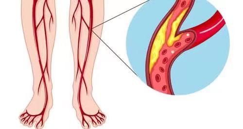 腿上出现哪些异常说明血管堵了