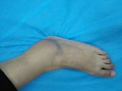 踝关节扭伤份哪些类型，不小心崴脚的紧迫处理办法有哪些 — 爱达夫摄生
