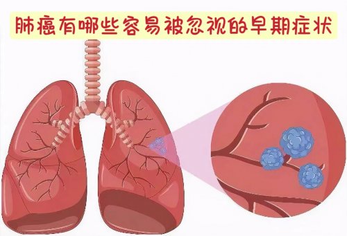 身体出现四种变化可能是肺癌在靠近要小心