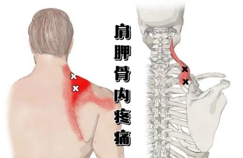 肩胛骨里面疼痛是什么原因导致的该如何预防