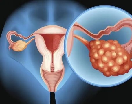 卵巢癌发现就是晚期吗下身四大异常信号要警惕