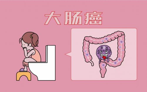 95%的大肠癌竟由肠息肉转变而来上厕所有这3个提示要警惕