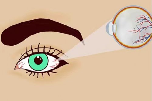眼睛有红血丝是怎么回事及红血丝与哪些疾病相关联